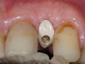 lateral incisor dental implant with customized healing abutment- healed occlusal kazemi oral surgery bethesda