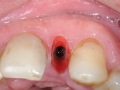 lateral incisor dental implant with customized healing abutment-tissue form kazemi oral surgery bethesda
