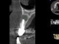 lateral incisor with cyst and bone loss CBCT kazemi oral surgery bethesda