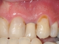 lateral incisor with periapical cyst infection kazemi oral surgery bethesda