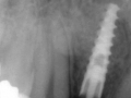 narrow diameter ritter 3.0 dental implant for lateral incisor with customized healing abutment xray kazemi oral surgery bethesda