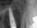 ritter dental implant 3.0 narrrow diameter final restoration- kazemi oral surgery bethesda
