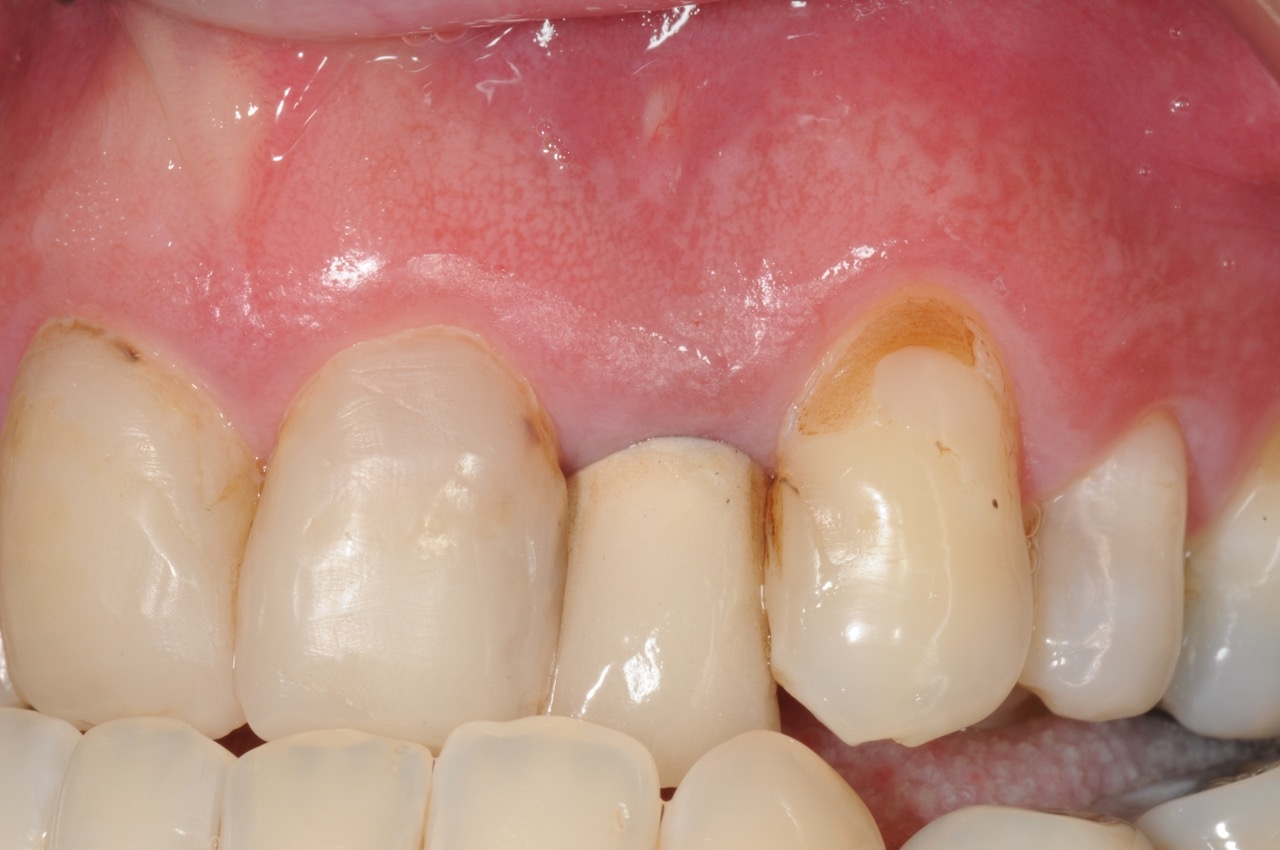 lateral incisor with periapical cyst infection kazemi oral surgery bethesda