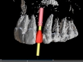 3-d computer assisted planning for implant lateral incisor digital waxup and implant position kazemi oral surgery bethesda
