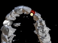 3-d computer assisted planning for implant lateral incisor digital waxup kazemi oral surgery bethesda