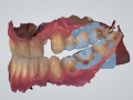 3 shape digital scan impression of dental implant kazemi oral surgery bethesda