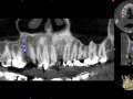 cbct of extraction site with grafting after healing kazemi oral surgery bethesda
