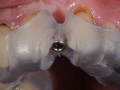 custom cad cam dental implant surgical guide kazemi oral surgery bethesda