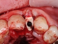lateral incisor dental implant placement with customized healing abutment surgery kazemi oral surgery bethesda