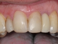 lateral incisor dental implant with customized abutment and crown restoration labial kazemi oral surgery bethesda