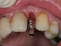 lateral incisor dental implant with customized healing abutment- impression pickup kazemi oral surgery bethesda