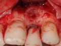lateral incisor with bone loss from cyst kazemi oral surgery bethesda