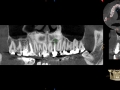 lateral incisor with cyst and bone loss kazemi oral surgery bethesda