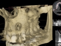 lateral incisor with cyst nd bone loss 3-d model kazemi oral surgery bethesda