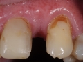 missing lateral incisor after bone grafting kazemi oral surgery bethesda