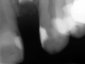 ritter dental implant 3.0 narrow diameter after placement kazemi oral surgery bethesda