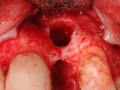 tooth extraction and removal of cyst kazemi oral surgery bethesda