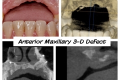 3.-anterior-maxillary-major-defect-before-bone-graft-connective-tissue-graft-kazemi-oral-surgery-dental-implants