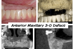 4.-anterior-maxillary-major-defect-after-bone-graft-connective-tissue-graft-kazemi-oral-surgery-dental-implants