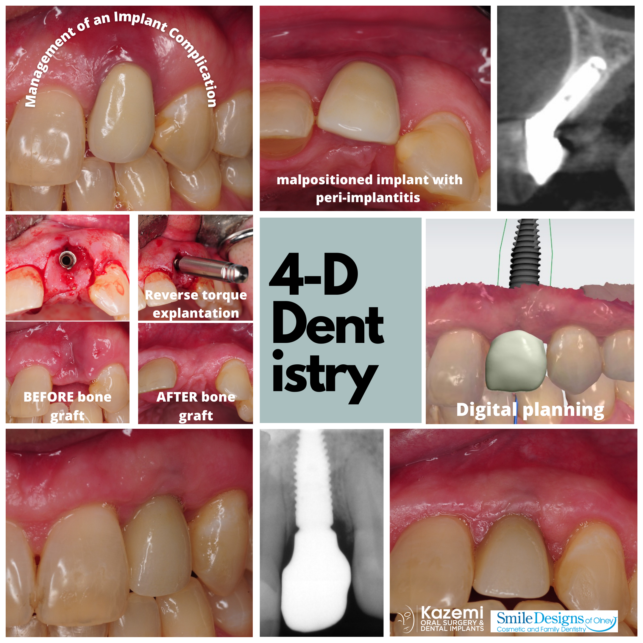 Revision treatment of a dental implant complication involving upper lateral incisor