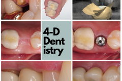 Dental implant replacement of a single missing tooth