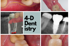 Lower molar replacement with a dental implant