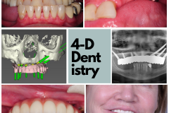 Full arch replacement of teeth in a patient with advanced bone loss