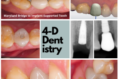 Tooth replacement with a dental implant