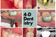 Replacement of a missing lower molar with dental implant