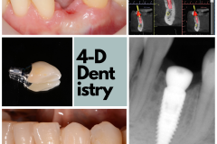 Replacement of lower canine