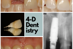 Fractured upper incisor replaced with a dental implant