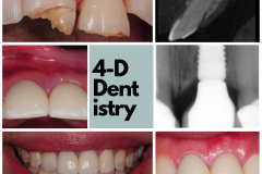 Implant replacement of incisor following traumatic fracture