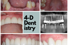 Complete replacement of missing teeth with dental implants