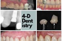 Upper canine replacement with a dental implant