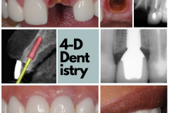 Central incisor replacement with a dental implant