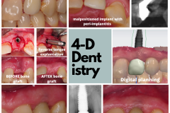 Revision treatment of a dental implant complication involving upper lateral incisor