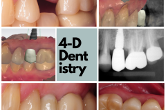 Upper premolar replacement with a dental implant