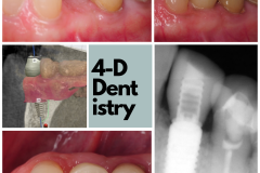 Digitally-driven dental implant therapy