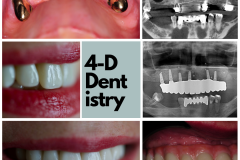 Full arch replacement of upper missing teeth with implants