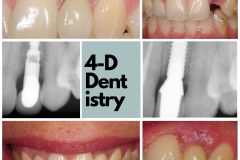 Revision treatment of a patient with receding gum tissue around dental implant