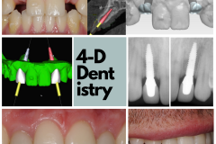 Dental implants to replace congenitally missing lateral incisors