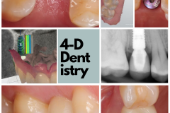 Premolar replacement with a dental implant