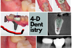Lower molar replacement with a dental implant
