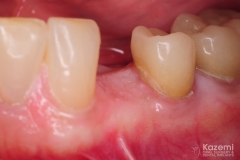 1.-digital-dental-implant-natrual-looking-easy-to-clean03
