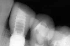 10.-digital-dental-implant-natrual-looking-easy-to-clean01