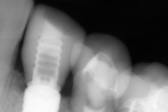 10.-digital-dental-implant-natrual-looking-easy-to-clean01