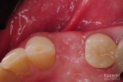 2.-digital-dental-implant-natrual-looking-easy-to-clean09