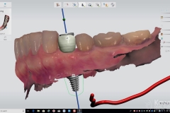 3.-digital-dental-implant-natrual-looking-easy-to-clean05