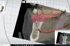 4.-digital-dental-implant-natrual-looking-easy-to-clean07