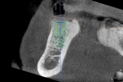 5.-digital-dental-implant-natrual-looking-easy-to-clean10